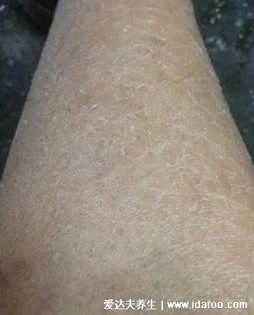 皮肤干燥脱屑像雪花图片,过热水洗澡可导致皮肤干燥症(4种可能)