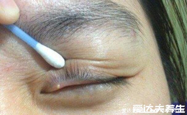 麦粒肿怎么消除快,可以热敷使用红霉素等药物(附麦粒肿早期图片)