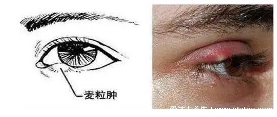 麦粒肿怎么消除快,可以热敷使用红霉素等药物(附麦粒肿早期图片)