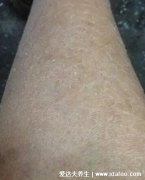 皮肤干燥脱屑像雪花图片,过热水洗澡可导