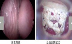 念珠菌性阴炎的症状图片,豆腐渣样白带伴