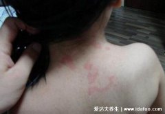 风疹图片和症状,低烧后红疹从面部蔓延至