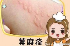 风疹块止痒小妙招,荨麻疹最怕四个土方法