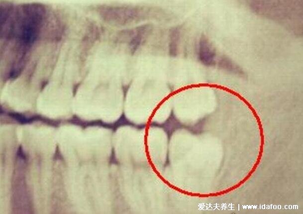 智齿一定要拔吗，4种情况不痛也必须拔(附不需要拔的智齿图片)
