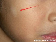 肚子里有蛔虫的症状图片，面部和指甲上突