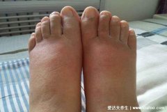 脚冻了痒痒怎么办能快速好，萝卜叶煮水泡