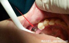 拔智齿后那个洞臭到恶心，拔牙后3-5天痛不