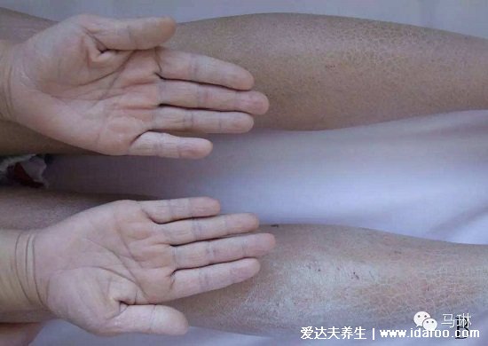 轻微鱼鳞病图片及症状图片,寻常型多见皮肤干燥(婴幼儿时期可发病)