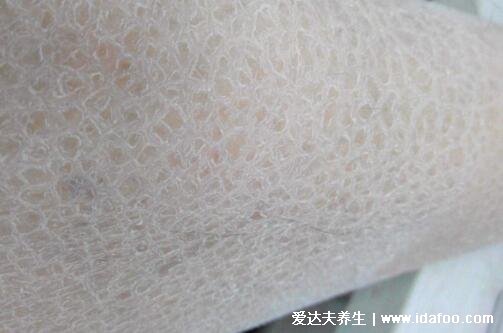 轻微鱼鳞病图片及症状图片,寻常型多见皮肤干燥(婴幼儿时期可发病)