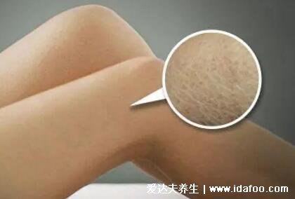 轻微鱼鳞病图片及症状图片,寻常型多见皮肤干燥(婴幼儿时期可发病)