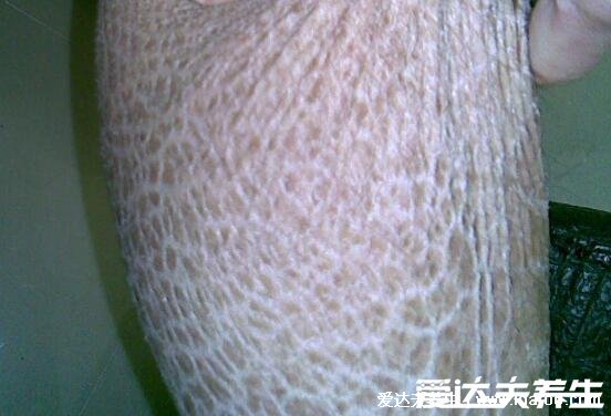轻微鱼鳞病图片及症状图片,寻常型多见皮肤干燥(婴幼儿时期可发病)