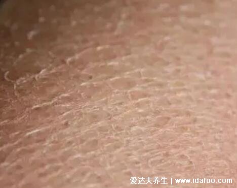 轻微鱼鳞病图片及症状图片,寻常型多见皮肤干燥(婴幼儿时期可发病)