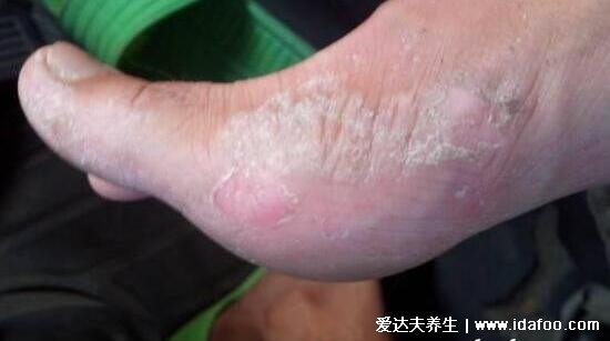 皮肤病图片对照大全查看图片,包含100种疾病的症状图自测