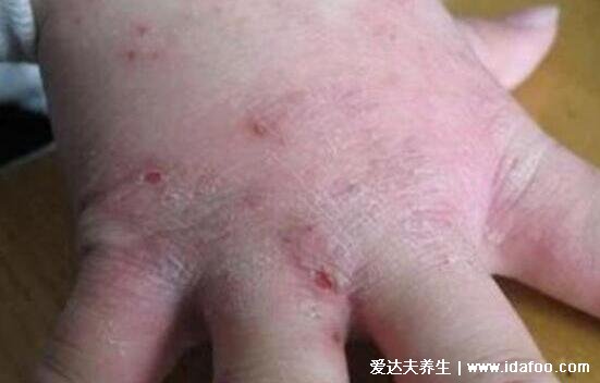 皮肤病图片对照大全查看图片,包含100种疾病的症状图自测