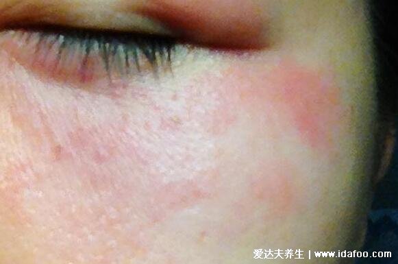 皮肤病图片对照大全查看图片,包含100种疾病的症状图自测