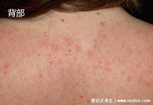 皮肤病图片对照大全查看图片,包含100种疾病的症状图自测