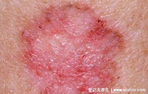 皮肤病图片对照大全查看图片,包含100种疾病的症状图自测