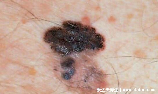 皮肤病图片对照大全查看图片,包含100种疾病的症状图自测