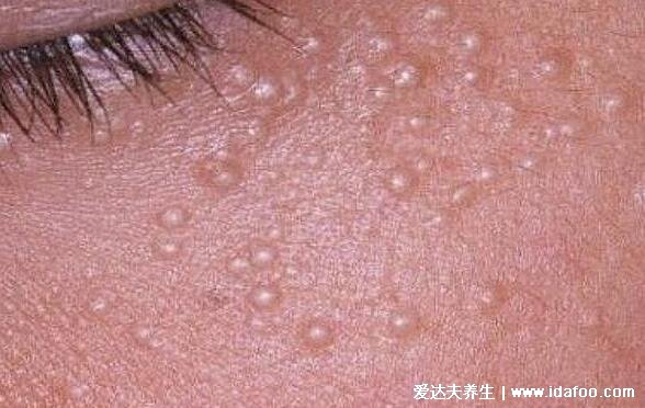 皮肤病图片对照大全查看图片,包含100种疾病的症状图自测