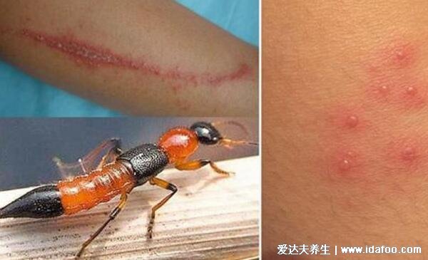 皮肤病图片对照大全查看图片,包含100种疾病的症状图自测
