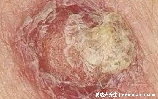 皮肤病图片对照大全查看图片,包含100种疾病的症状图自测