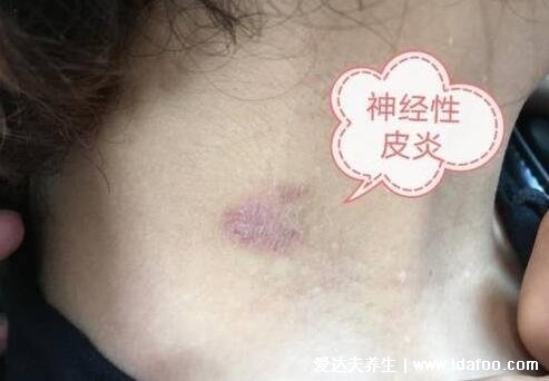 皮肤病图片对照大全查看图片,包含100种疾病的症状图自测