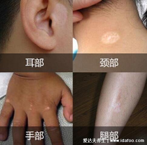 皮肤病图片对照大全查看图片,包含100种疾病的症状图自测