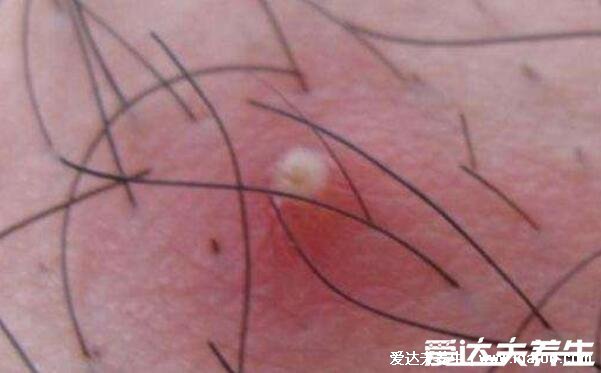 皮肤病图片对照大全查看图片,包含100种疾病的症状图自测