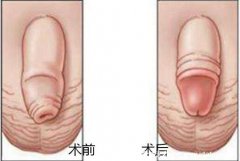 包茎手术20天恢复图片,男生割包茎会变大吗