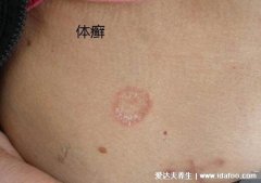 100种癣对照图片及早期症状,牛皮癣足癣体