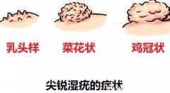 尖锐湿尤图症状图片男性症状，隐私部位现