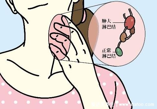 颈部淋巴结肿大图片,脖子肿大是症状之一(引起原因有很多警惕淋巴瘤)