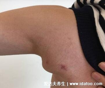 颈部淋巴结肿大图片,脖子肿大是症状之一(引起原因有很多警惕淋巴瘤)