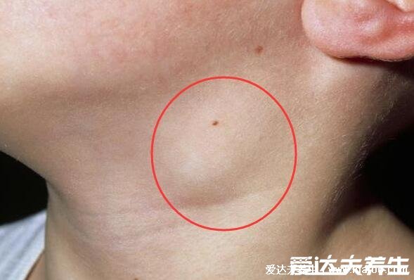 颈部淋巴结肿大图片,脖子肿大是症状之一(引起原因有很多警惕淋巴瘤)