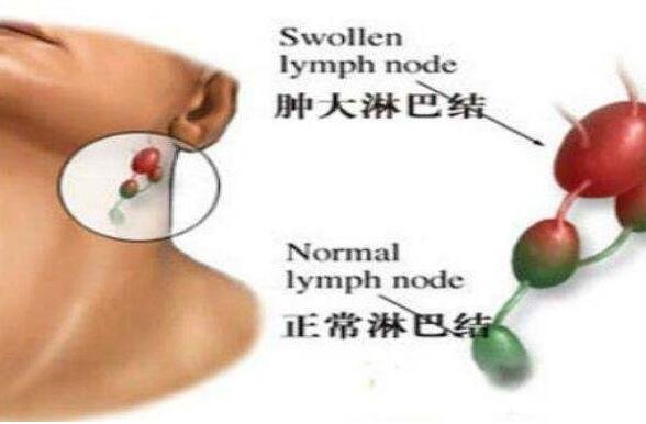 颈部淋巴结肿大图片,脖子肿大是症状之一(引起原因有很多警惕淋巴瘤)