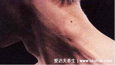 颈部淋巴结肿大图片,脖子肿大是症状之一(引起原因有很多警惕淋巴瘤)