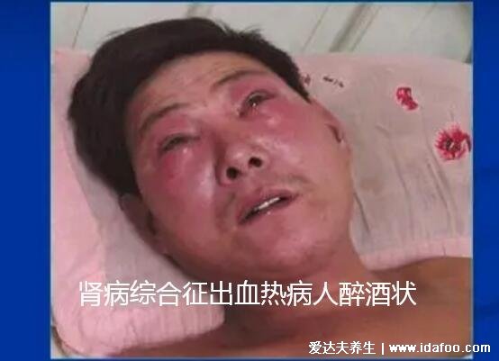 出血热皮肤病图片及症状,注意身上红疹图片及三红症状照片
