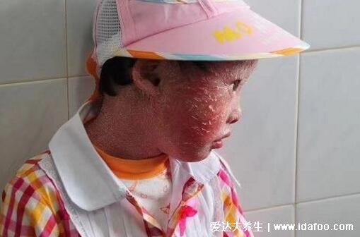 轻微初期鱼鳞病图片及症状,5种类型寻常型鱼鳞病最常见