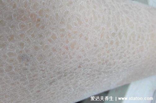 轻微初期鱼鳞病图片及症状,5种类型寻常型鱼鳞病最常见