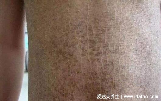 轻微初期鱼鳞病图片及症状,5种类型寻常型鱼鳞病最常见