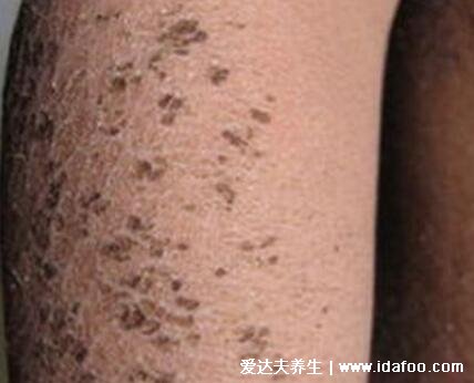 轻微初期鱼鳞病图片及症状,5种类型寻常型鱼鳞病最常见