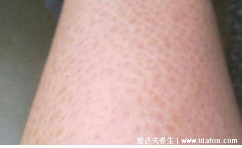 轻微初期鱼鳞病图片及症状,5种类型寻常型鱼鳞病最常见