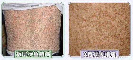 轻微初期鱼鳞病图片及症状,5种类型寻常型鱼鳞病最常见