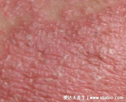 轻微初期鱼鳞病图片及症状,5种类型寻常型鱼鳞病最常见