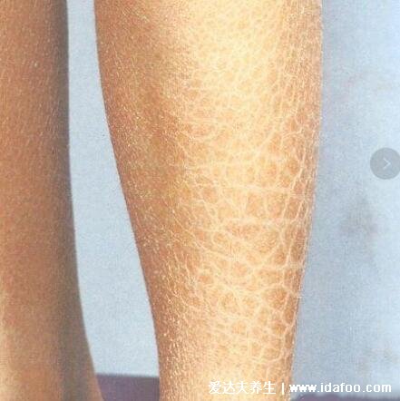 轻微初期鱼鳞病图片及症状,5种类型寻常型鱼鳞病最常见
