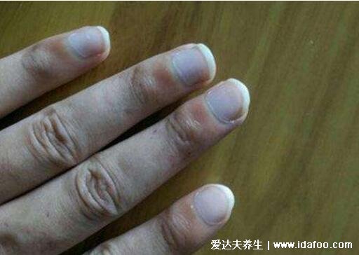 早期林赛氏指甲和正常对比图片,警惕慢性肾衰竭(多为营养不良)