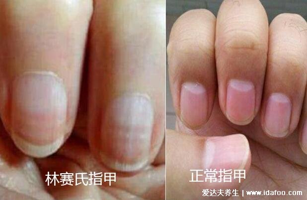 早期林赛氏指甲和正常对比图片,警惕慢性肾衰竭(多为营养不良)