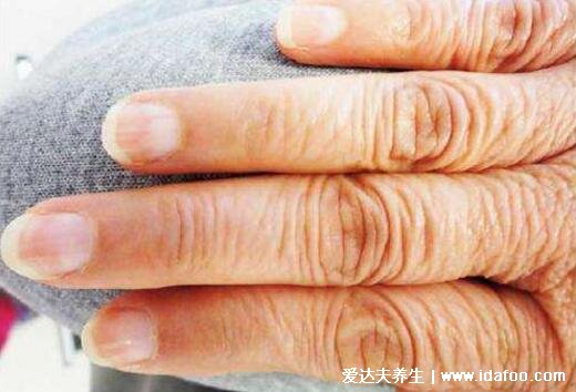 早期林赛氏指甲和正常对比图片,警惕慢性肾衰竭(多为营养不良)