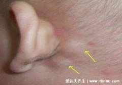 耳后淋巴结肿大图片，不痛不痒质地坚硬的