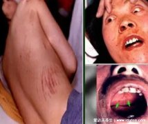 出血热皮肤症状图片,可出现高热现象还可